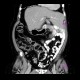 Situs viscerum inversus: CT - Computed tomography